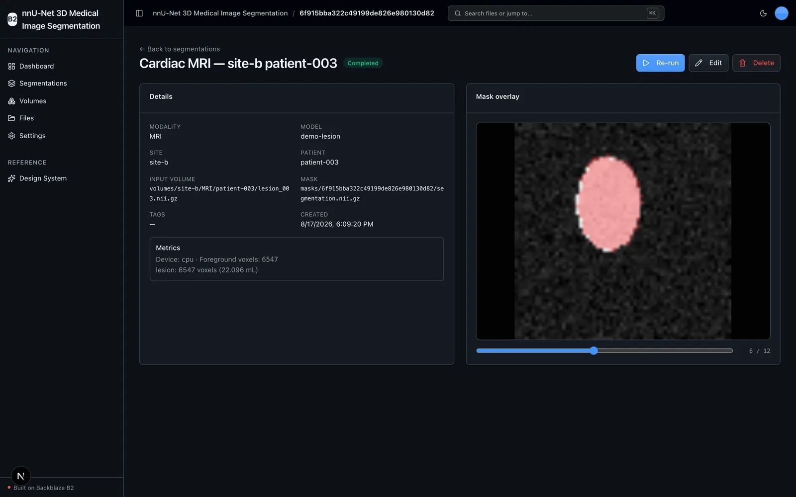 Completed segmentation job showing the lesion mask overlaid on an MRI slice with metrics